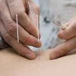techniques d"acupuncture