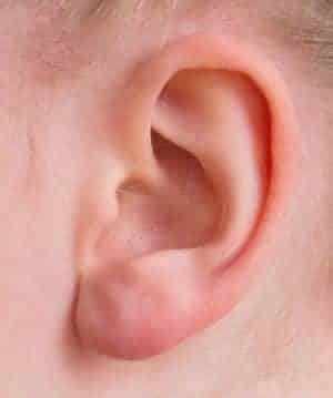 Acupuncture oreille Valence auriculo