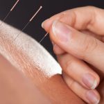techniques d'acupuncture