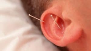 auriculothérapie, acupuncture de l'oreille